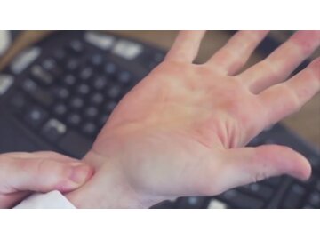 Hand and Wrist Injuries - Carpal Tunnel Syndrome: What is Carpal Tunnel Syndrome?