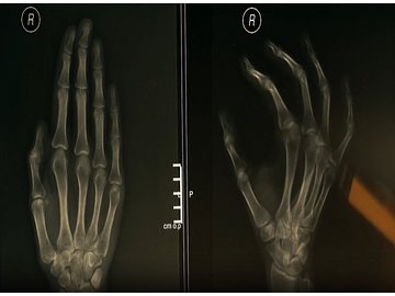Carpal Tunnel Syndrome - Orientation